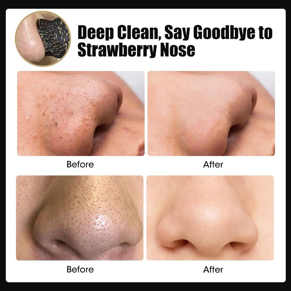 Remove Blackhead Blemish - upzone